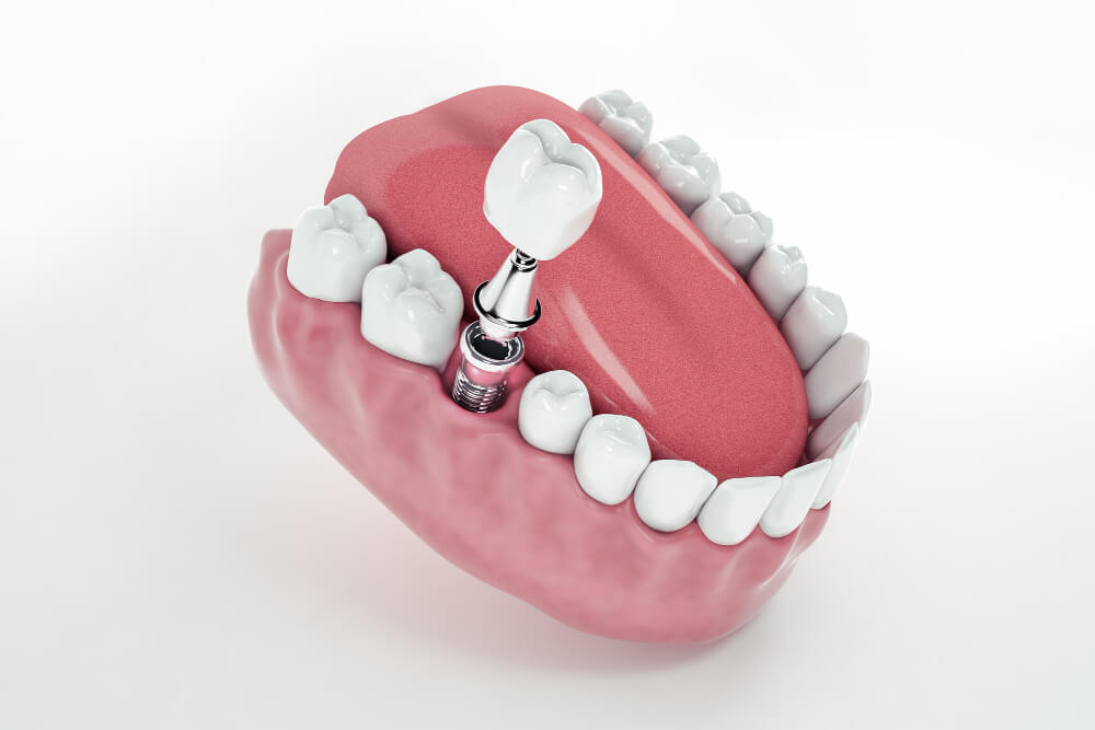 Dental implants in Mount Vernon, NY