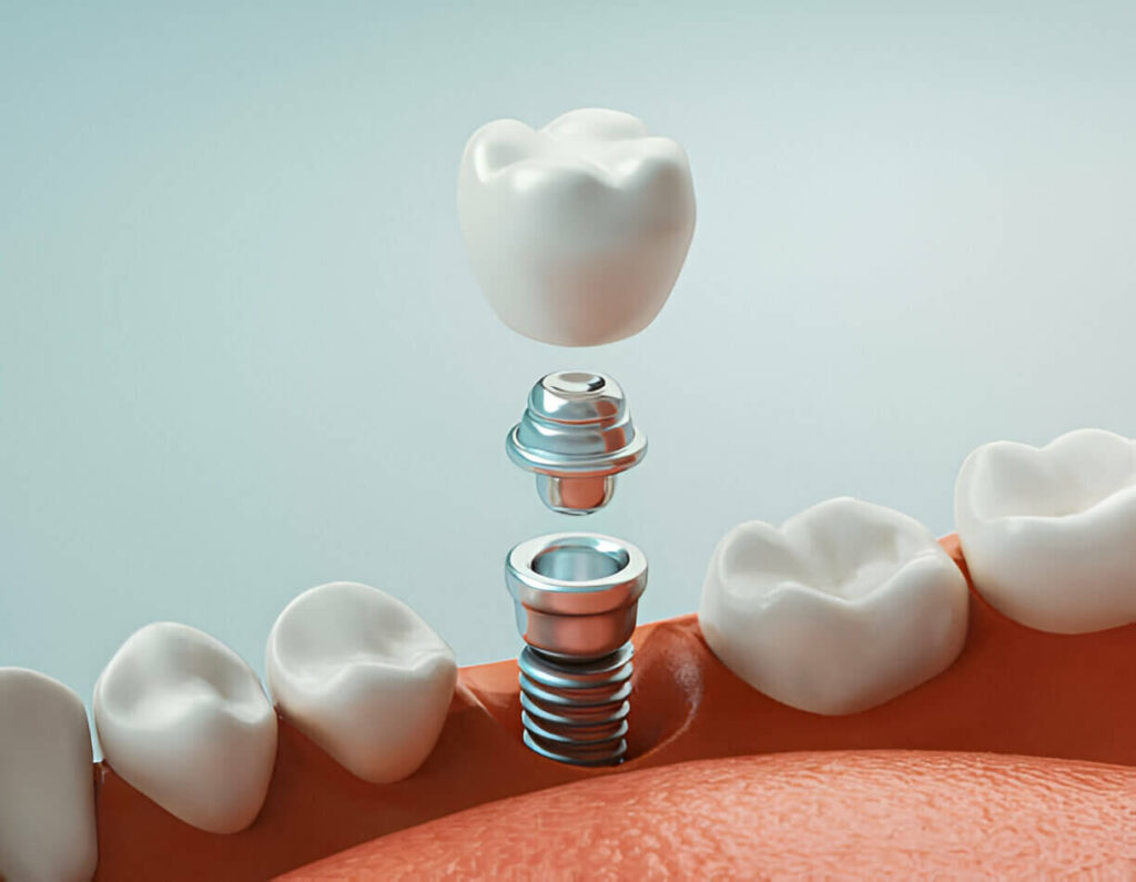 Dental implants in Mt Vernon, NY