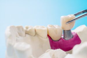 Restorative dentistry in Mt. Vernon, NY