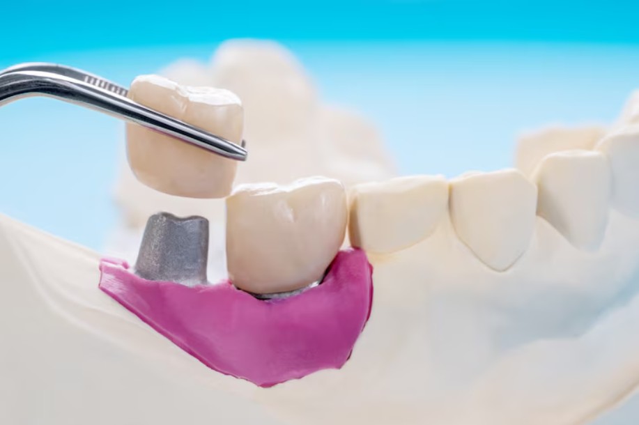 Restorative dentistry in Mt. Vernon, NY2
