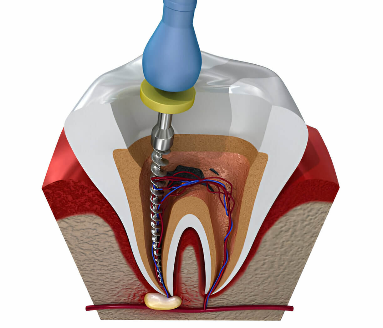 Root Canal treatment in Mt Vernon NY