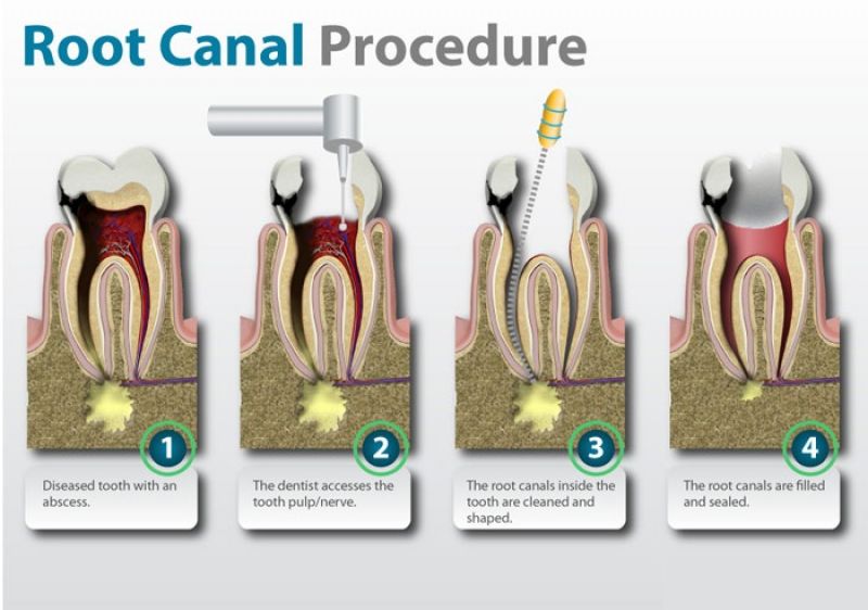 Root Canal treatment in Mt Vernon, NY