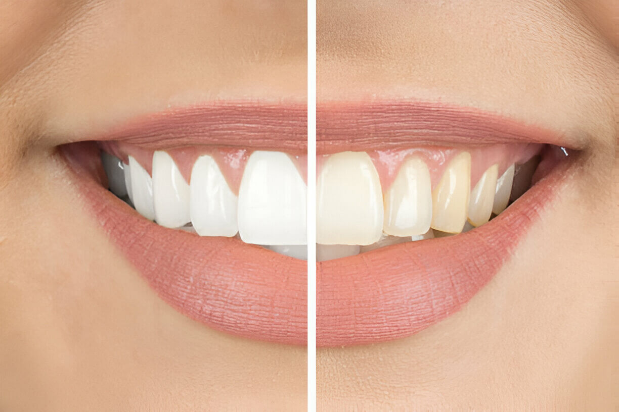 Teeth Whitening in Mt Vernon NY