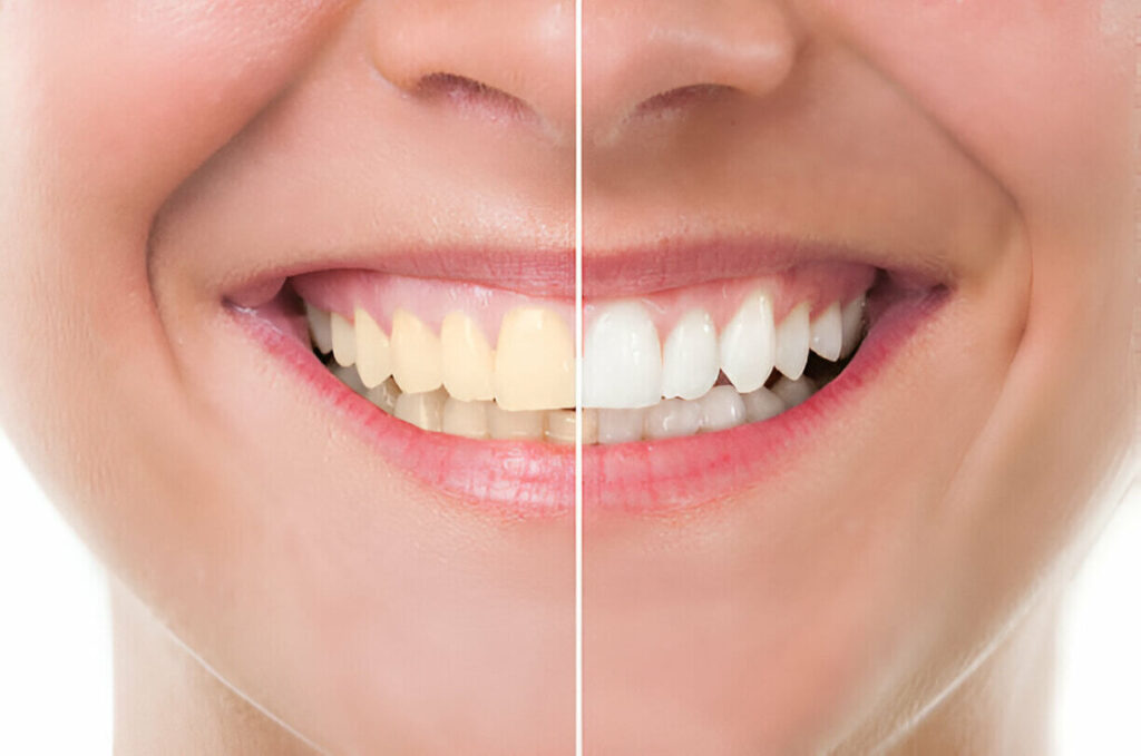 Teeth Whitening in Mount Vernon, NY