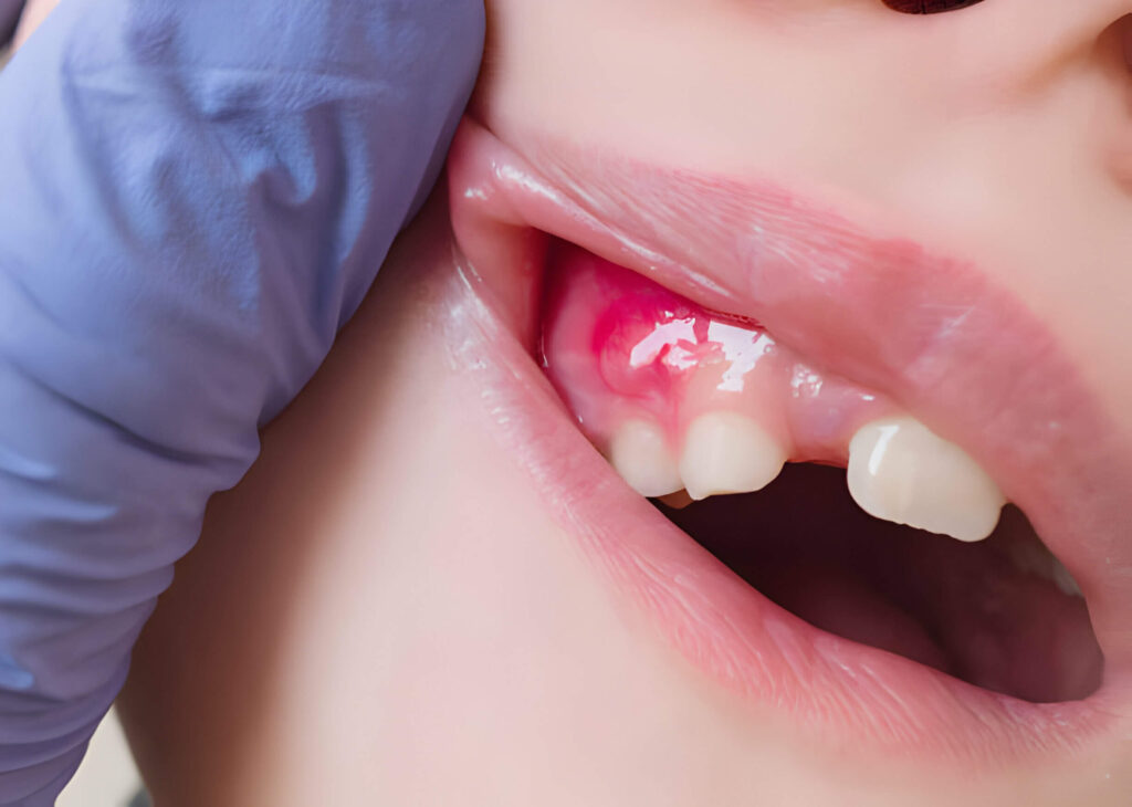 tooth infection treatment in Mt Vernon NY